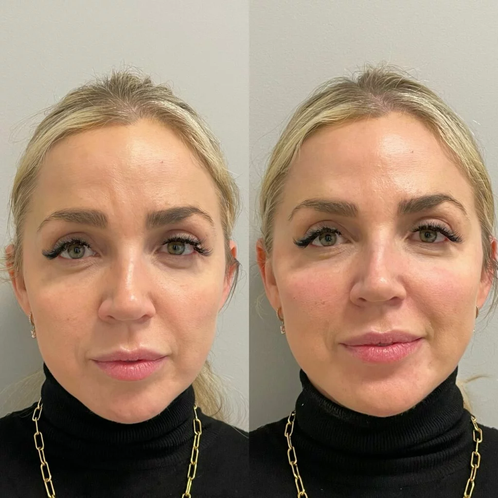 Exploring Deep Medial Cheek Fat Area Filler with Dr. Laura Geige